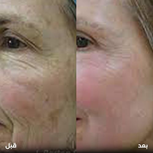 التقشير بأنواعه