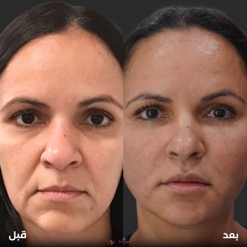 خيوط شد الوجه والرقبة