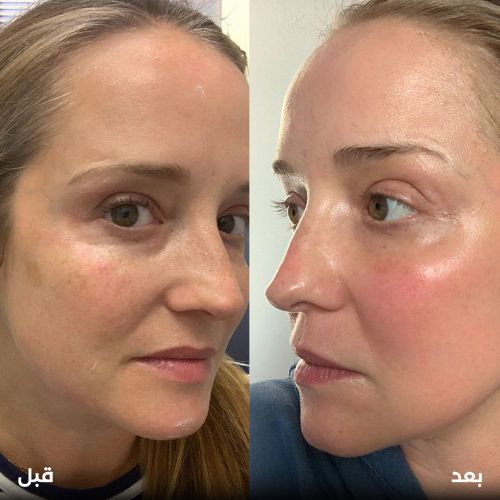 فرنكشال-ليزر