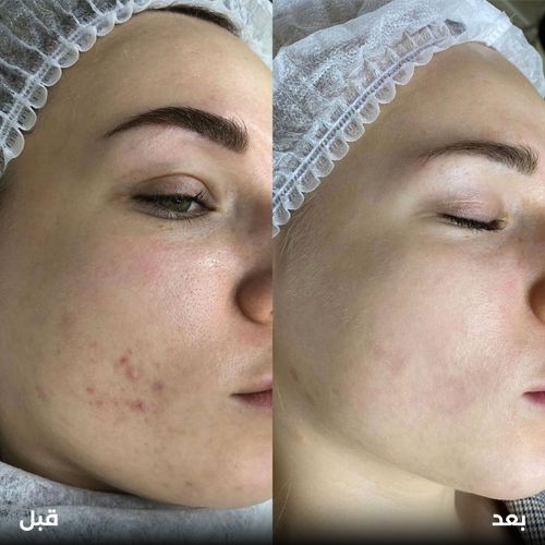 ليزر كربوني